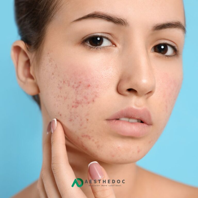 Acne Scars Spots Spits Treatment in Pakistan