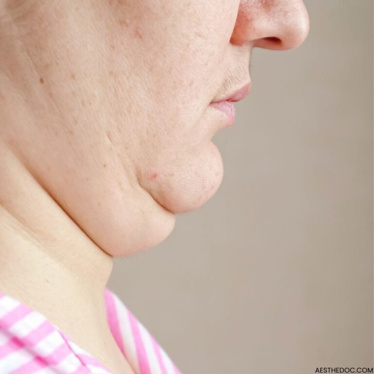 Double Chin Fat Reduction Treatment Options Islamabad Lahore Karachi Peshawar Sialkot Gujranwala