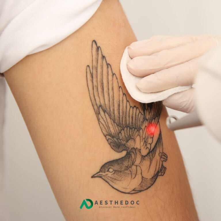 Laser Tatto Removal Treatment Cost in Islamabad, Pakistan