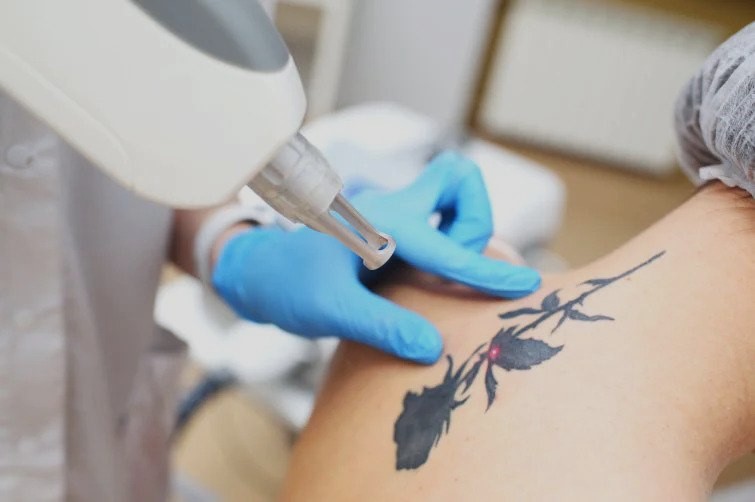 Laser Tatto Removal Treatment Cost in Islamabad, Pakistan