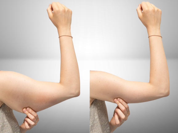 Non Surgical Arm Lift in Multan, Aesthedoc