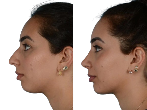 Non Surgical Nose Job Cost in Faisalabad, Pakistan