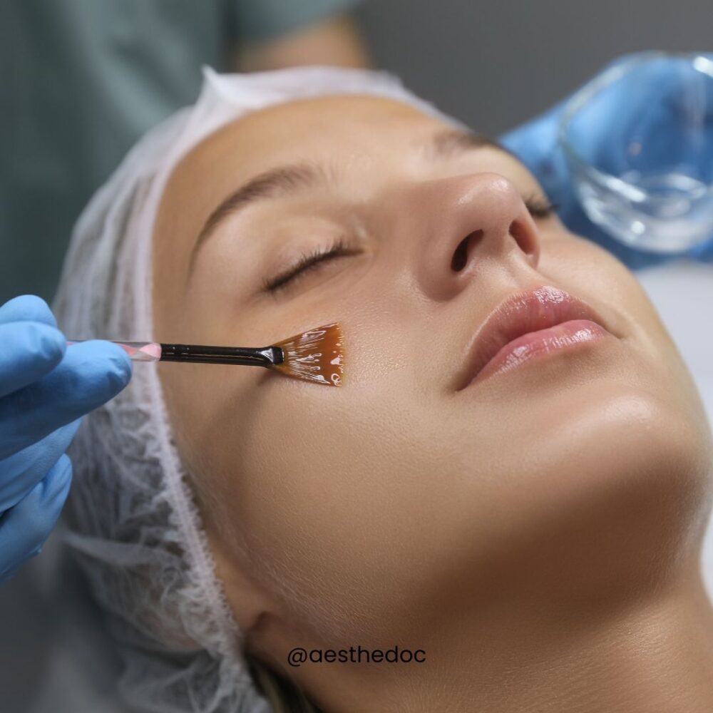 Chemical Peels Treatments in Islamabad Rawalpindi Lahore Karachi Pakistan