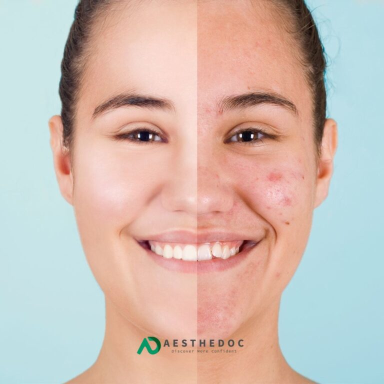 Acne Scars Treatment Cost in Pkistan