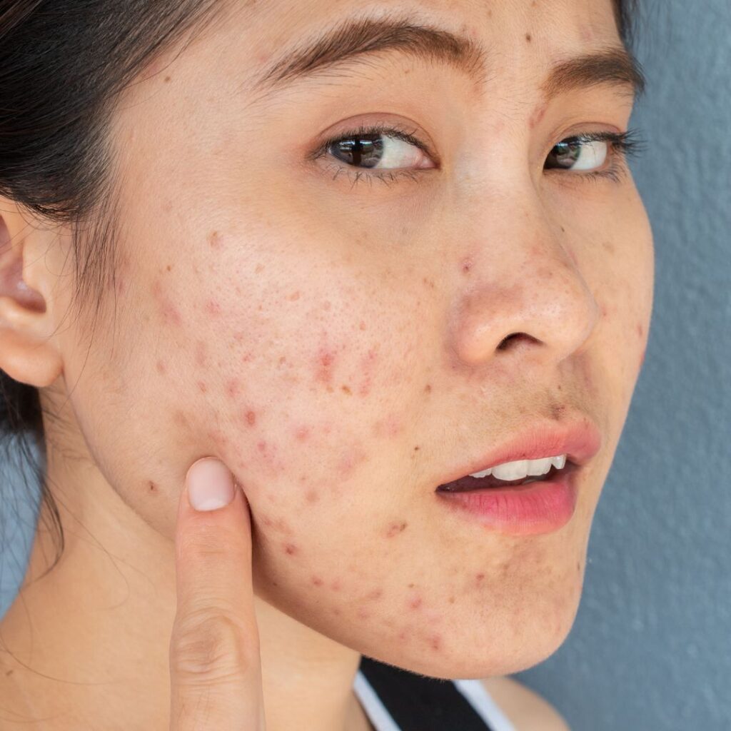 Acne Scars Erbium Laser Treatment