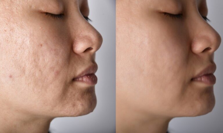 Acne Scars Simple Treatments for Smooth, Clear Skin